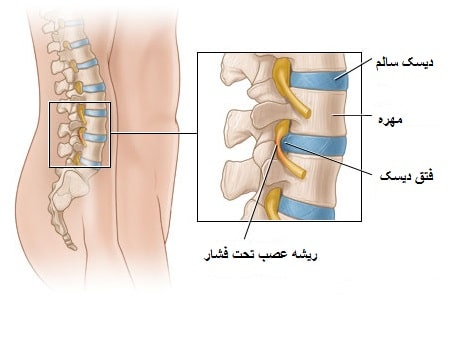 دیسک فتق کمری
